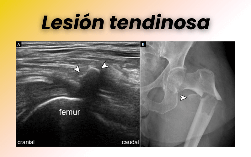 3. Patologia compartimento anterior cadera tempo formacion.png